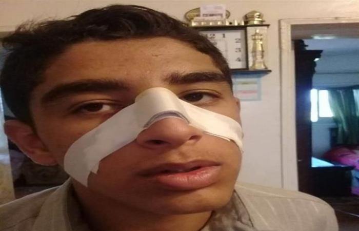 طالب يكسر أنف زميله داخل المدرسة بالحسينية 1 طالب يكسر أنف زميله